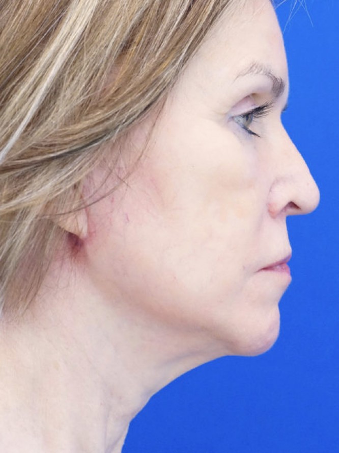 Deep Plane Lift and Fat Grafting — After
