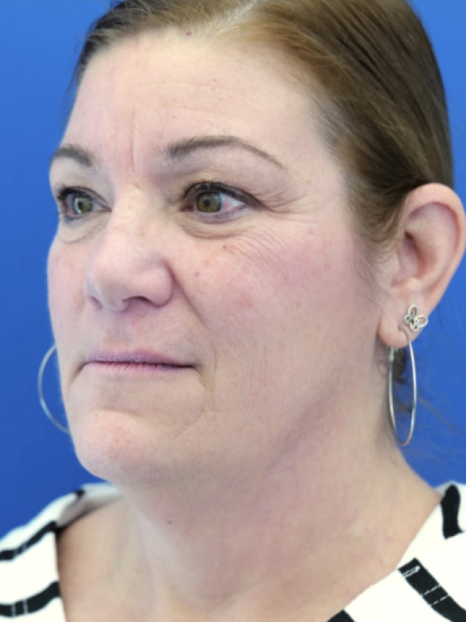 Full Upper and Lower Facelift — Before