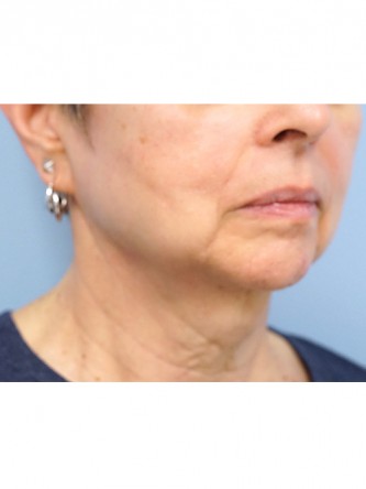 Neck Lift* — Before