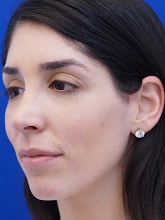 Nasal Bridge Bump* — After