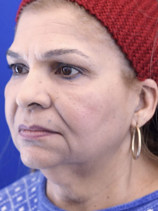Necklift and Liposuction — Before