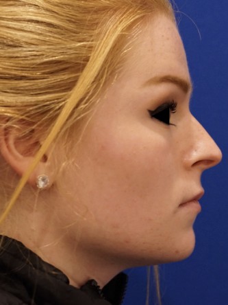 Tip and Lip* — Before