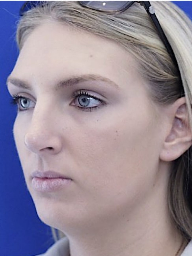 Tension Nose — Before