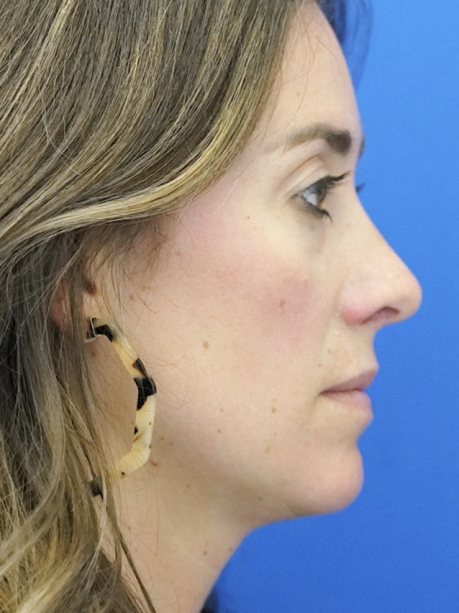 Preservation Rhinoplasty — After
