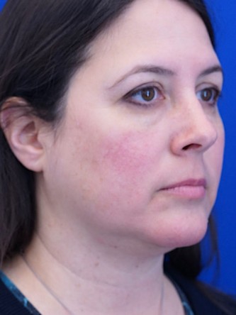 Facelift, Eyelid Lift, and Chin Liposuction* — Before