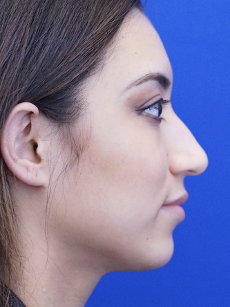Feminine Nasal Tip* — Before