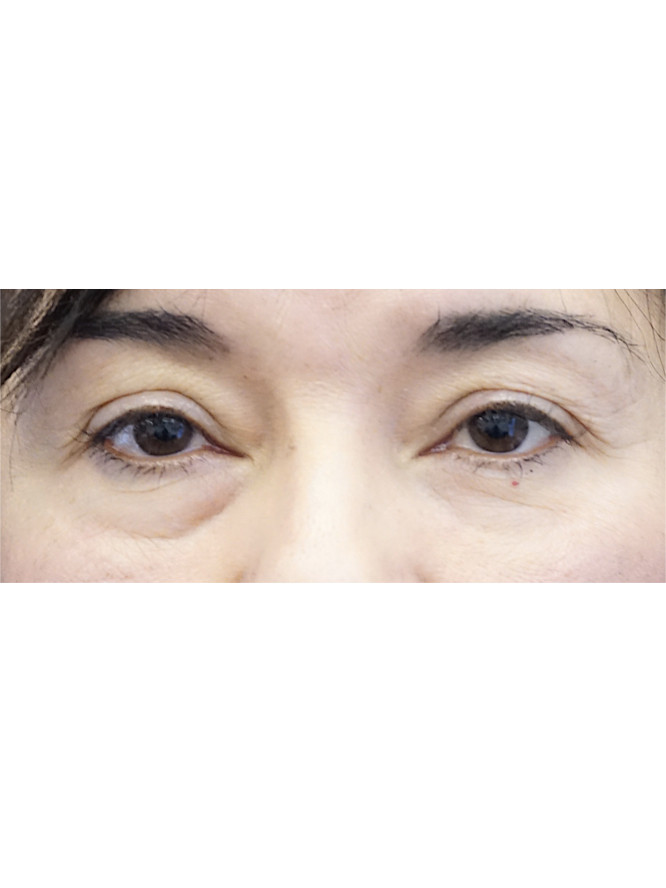 Four Quadrant Blepharoplasty with Fat Reposition — Before