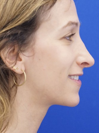 Long Nose Hanging Columella — Before