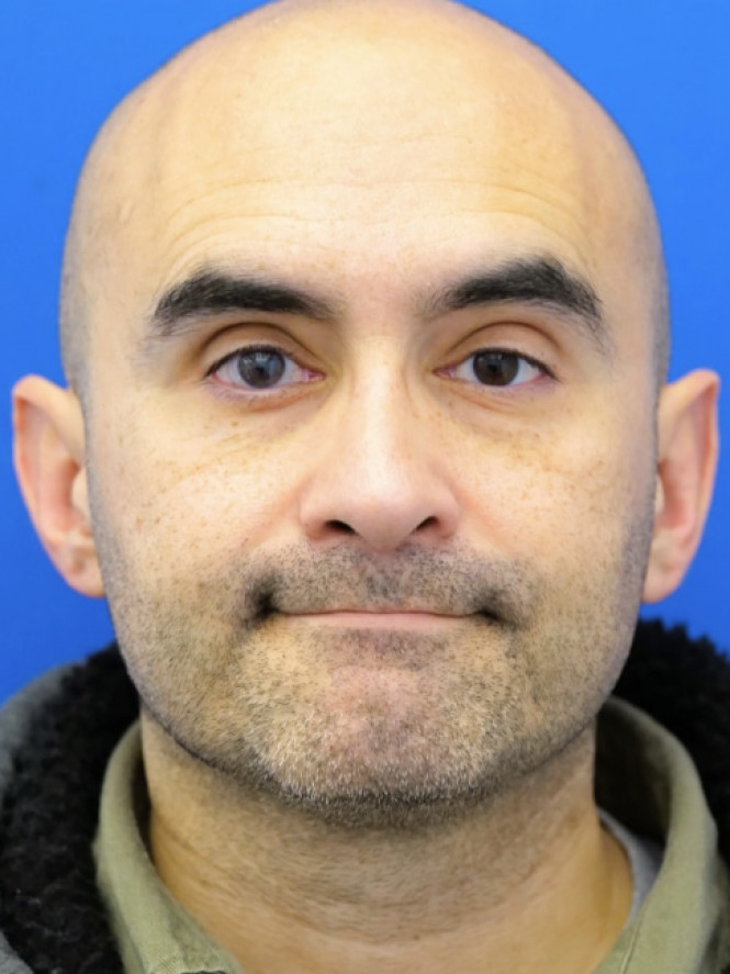 Tension Tip Ptosis — After