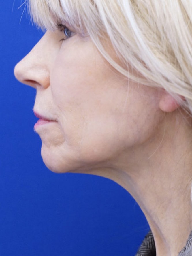 Crisp Jaw and Neck Lines — Before