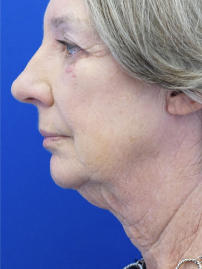 Deep Plane Face and Neck Lift — Before