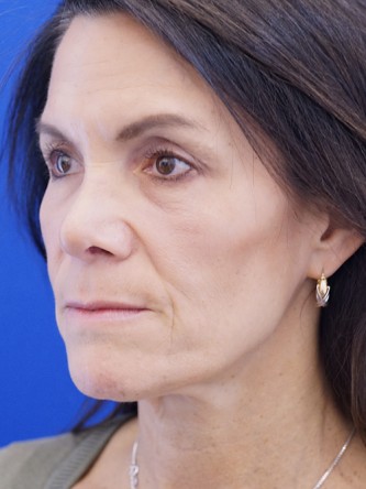 Nasal Tip Deformity — After