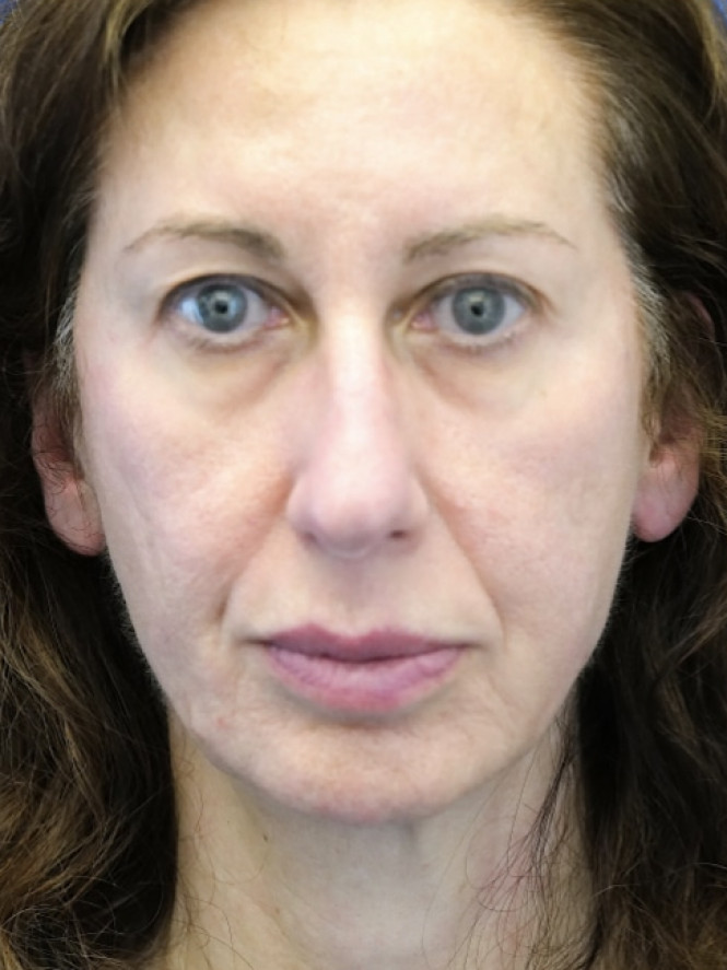 Natural Result — Before