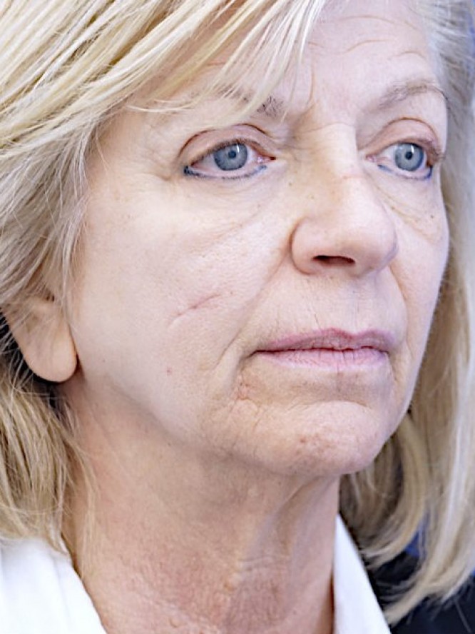 Jowls and Loose Neck Skin — Before