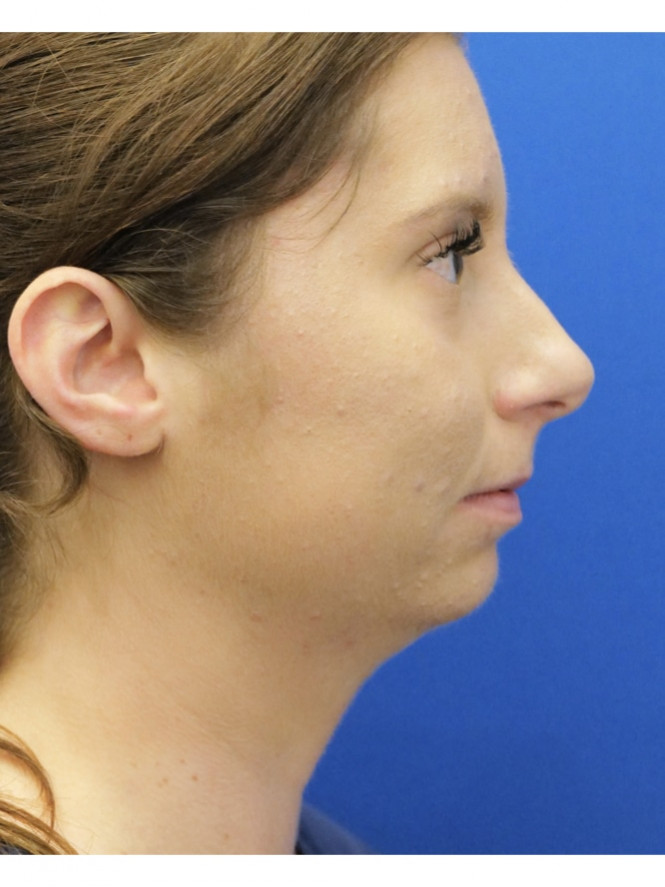 Chin Augmentation and Liposuction — Before