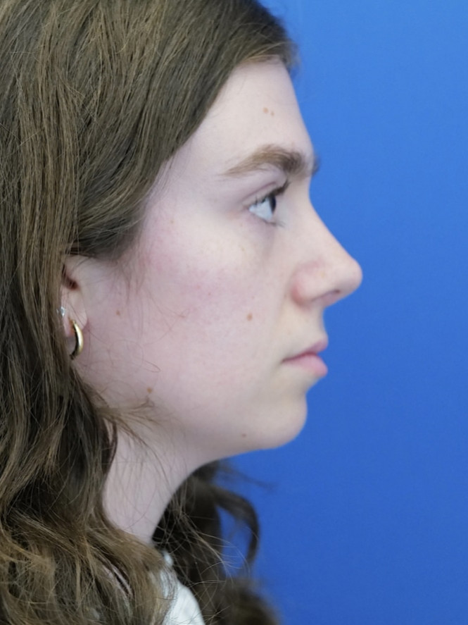 Preservation Rhinoplasty1 — After