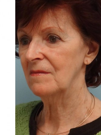 Facelift, Necklift, Platysmaplasty, ERB:YAG Laser Resurfacing* — Before