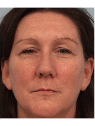 Juvederm to Upper Lip* — Before