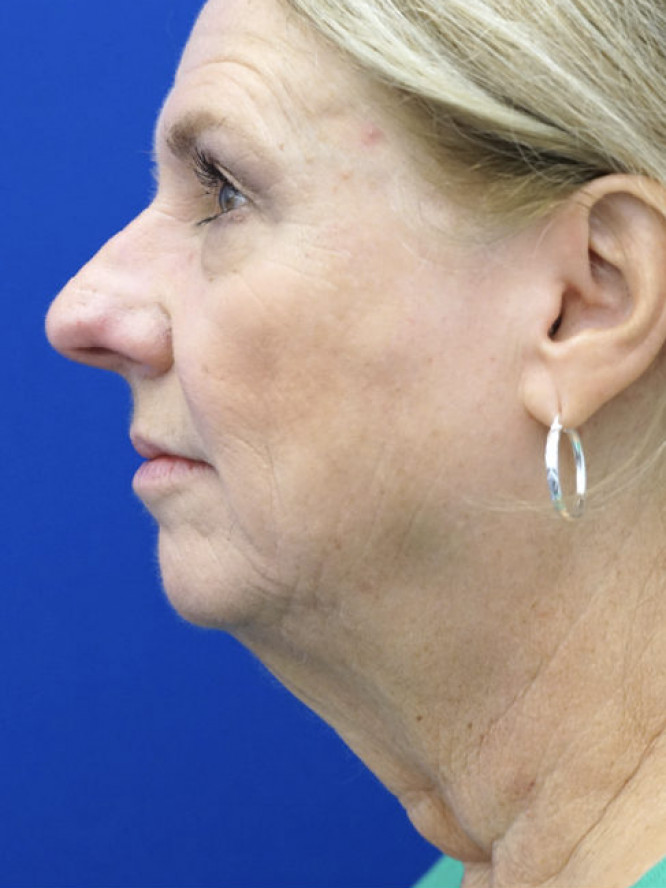 Lower Facial Aging and Fullness — Before