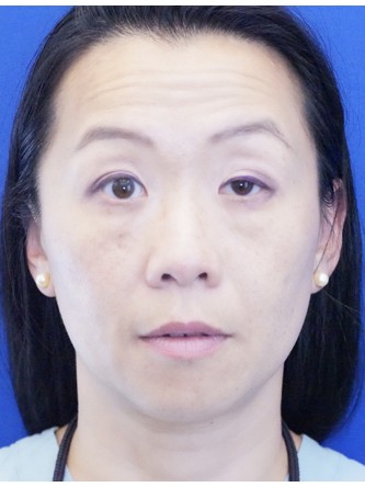 Unilateral Ptosis Repair* — Before