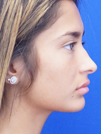 Voluptuous Lip Enhancement* — After