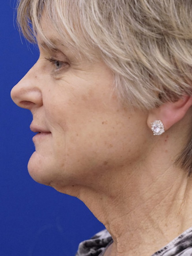 Lower Facelift Deep Plane — Before