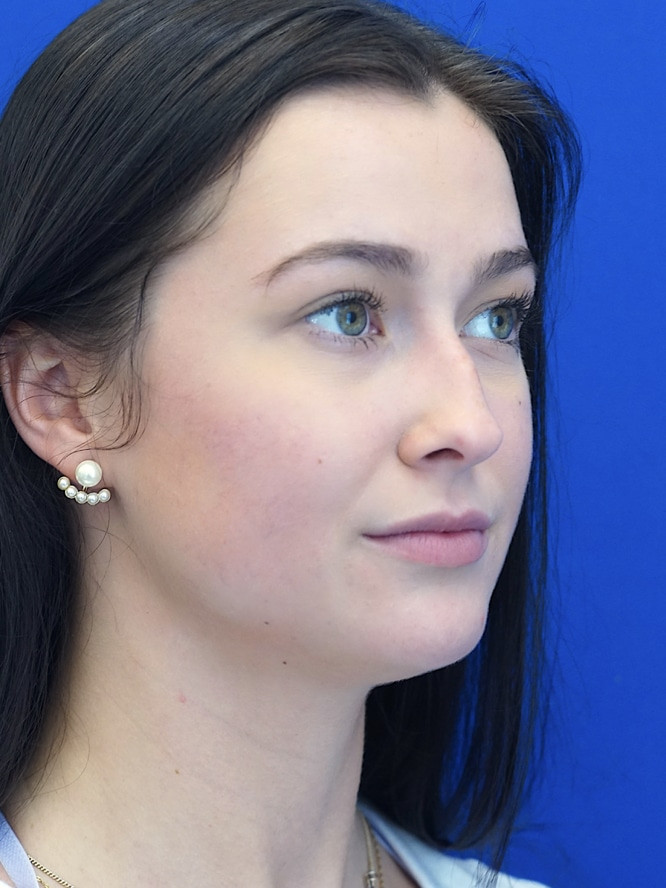 Soften Nasal Bridge — Before