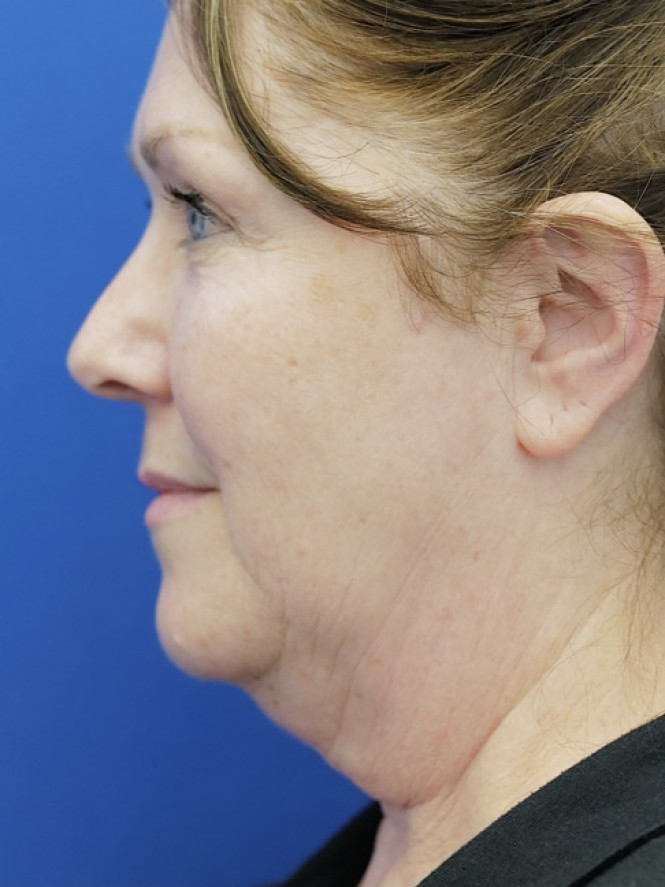 Beautiful Natural Result — Before