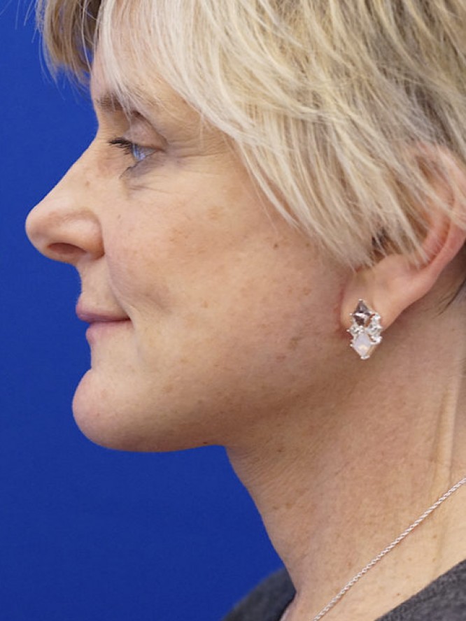 Lower Facelift Deep Plane — After