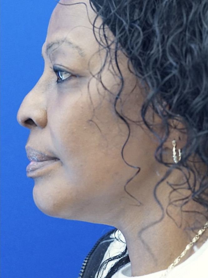 Necklift Platysma Suspension and Liposuction — After