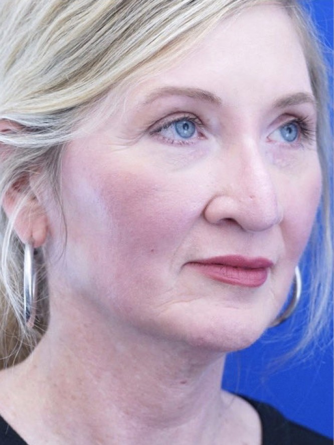 Thick Skin Droopy Nose — Before