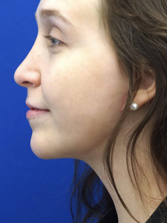 Necklift Subplatysmal Lipectomy — After