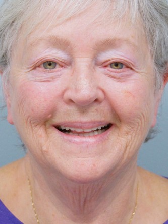 Aging Eyelid, Facelift, Necklift, Fractional CO2 Laser Resurfacing* — Before