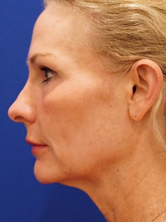 Mini Facelift* — Before