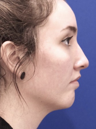 Upper Lip Fullness* — After
