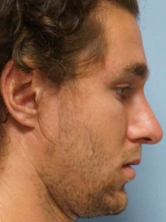 Crooked Nose & Dorsal Hump2* — After