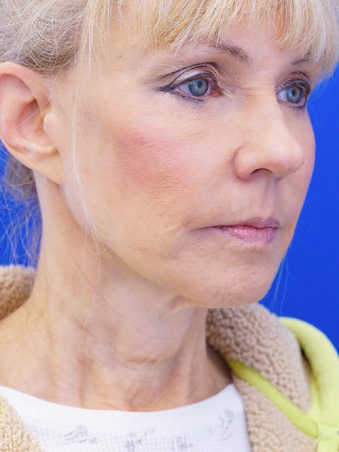 Neck Rejuvenation — Before