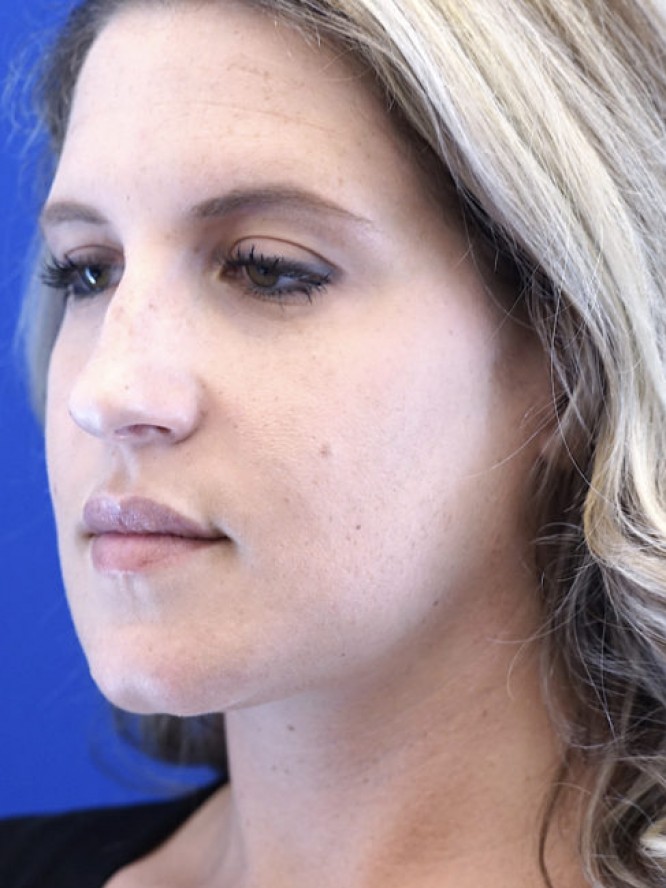 Aesthetic Nasal Profile — Before