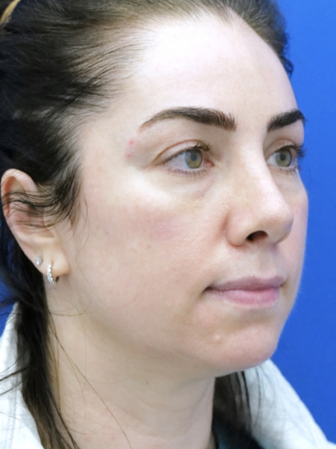Tip Asymmetry — After