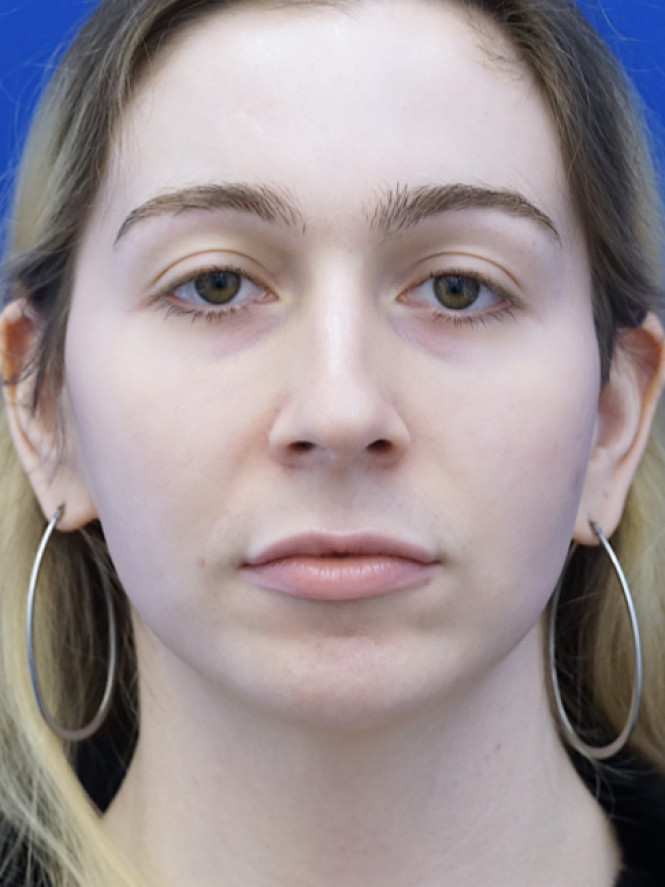 Soften Nasal Contour — Before