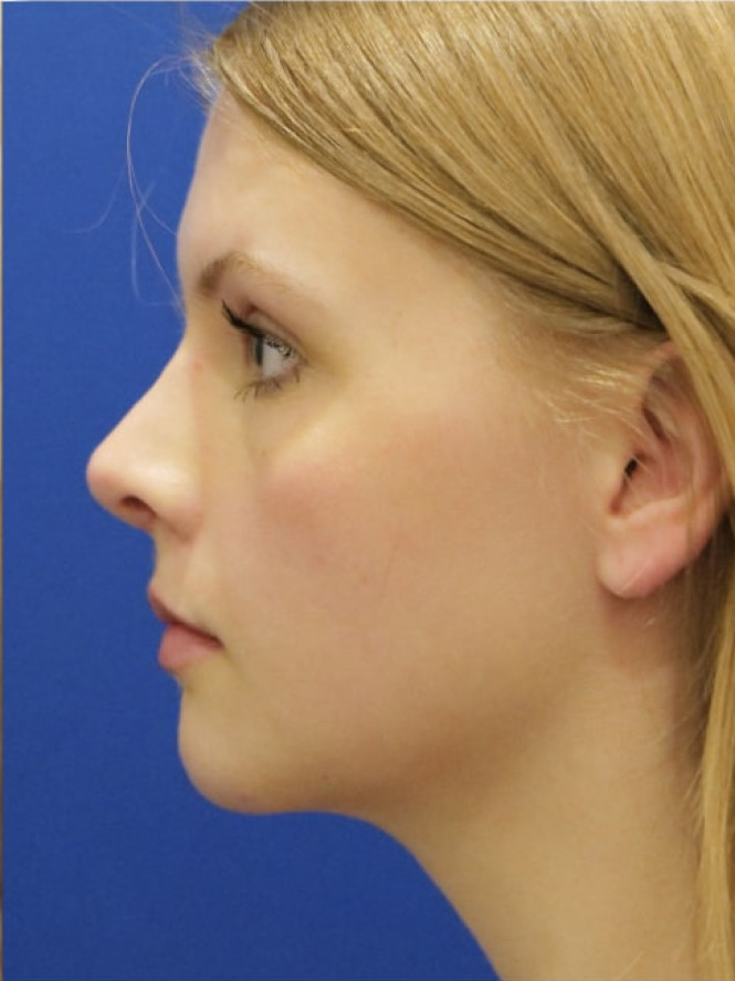 Soften Nasal Appearance — After