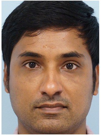 Restylane to Tear Trough – Under Eye* — After