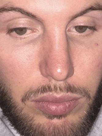 Nasal Upper Third Bony Asymmetry* — Before