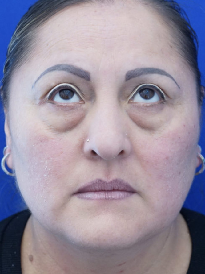 Lower Blepharoplasty Fat Reposition — Before