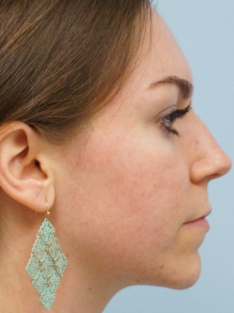 Fractional CO2 Laser Skin Resurfacing1* — After