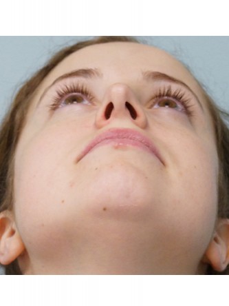Crooked Nose Endonasal Technique1* — Before