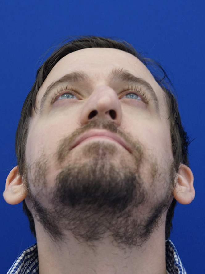 Crooked Thick Skin Nose — Before