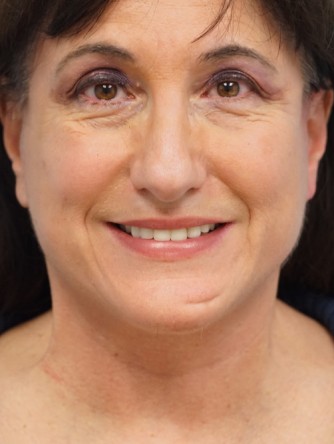 Mini Face and Neck Lift* — After