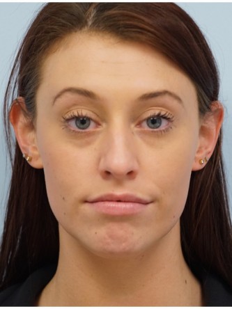 Cupid’s Bow Enhancement by Juvederm* — Before