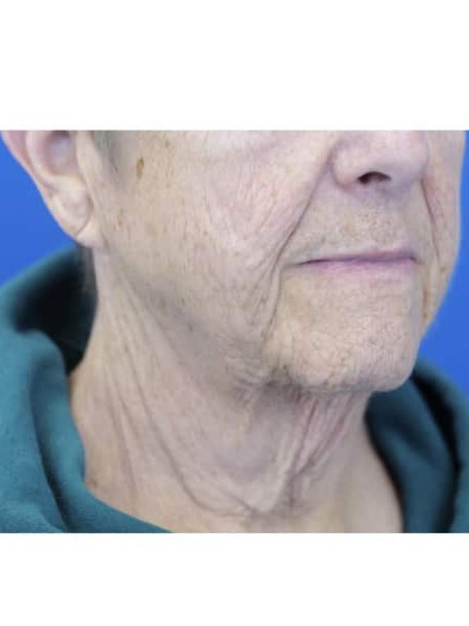 Neck Tissue Laxity — Before